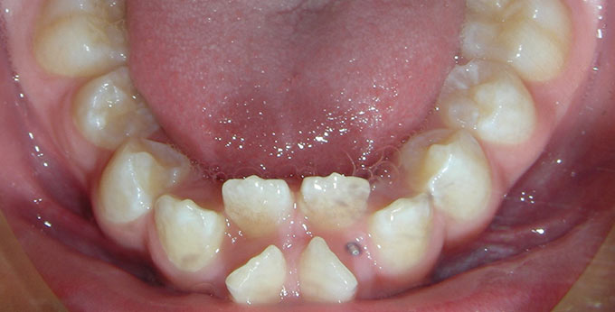 Before Orthodontic treatment consisting of removal of four premolar teeth followed by lower braces.